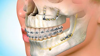 cirurgia-ortognatica-quanto-custa