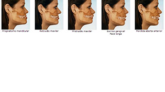 cirurgia-ortognatica-recuperacao