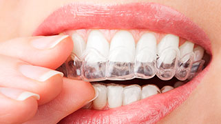 clareamento dental caseiro antes e depois