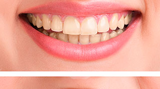 clareamento-dental-preco-laser