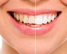 clareamento-dental-promocao
