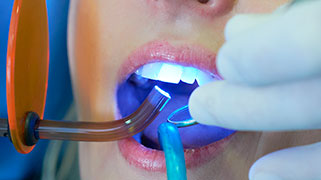 clareamento dos dentes a laser preço