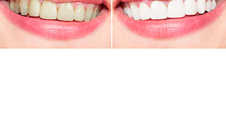 como-clarear-os-dentes-rapidamente