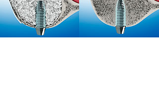 enxerto-osseo-odontologia