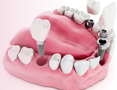 implante-dentario