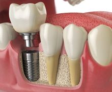 Implante dentário valor