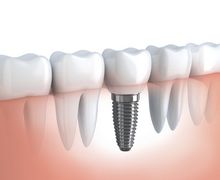 implantes-dentarios-preco