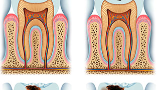 nevralgia-dentaria-tratamento