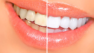 o que clareia os dentes?