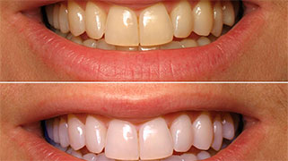 processo de clareamento dental
