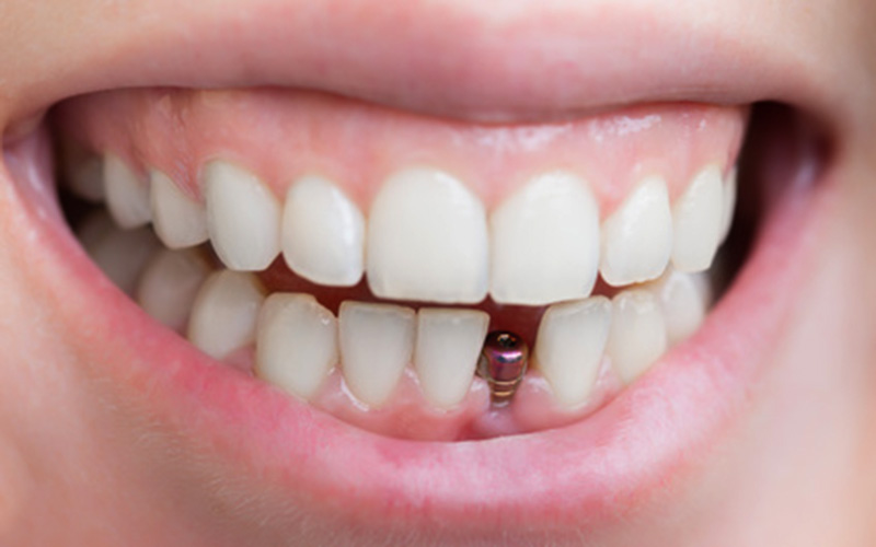 quanto-custa-um-implante-dentario